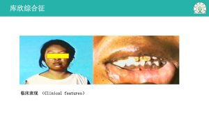 欣综合症状原因深度剖析-